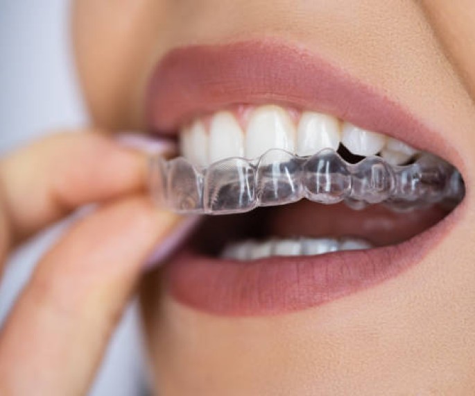 Aligner in mouth