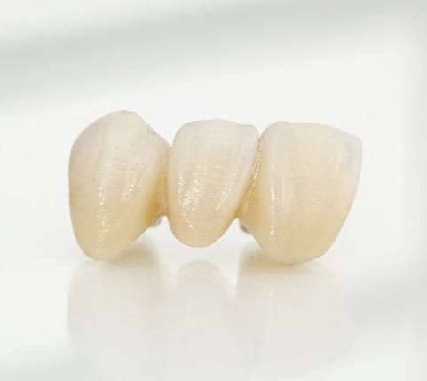 Dental Bridge - Crowns