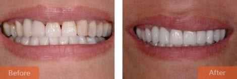 cosmetic dentistry crowns 470x157 - Cosmetic Dentistry