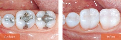 cosmetic dentistry inlay onlay 470x157 - Cosmetic Dentistry