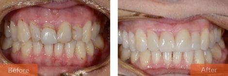 cosmetic dentistry veneers 470x157 - Cosmetic Dentistry