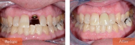 dental implants 470x157 - Dental Implants