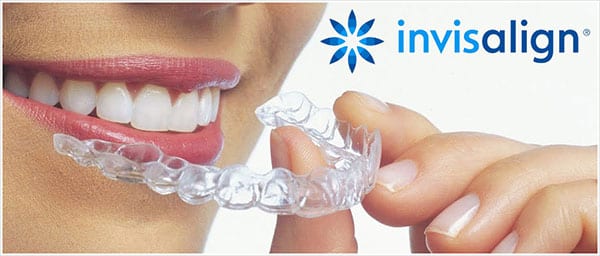 invisalign - Orthodontic braces