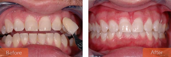 teeth whitening 2 - Teeth Whitening