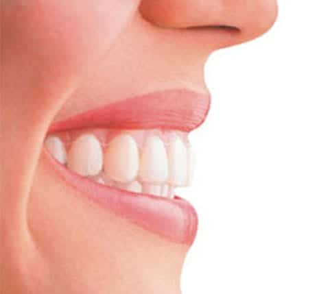 Adult Invisalign - Orthodontic braces